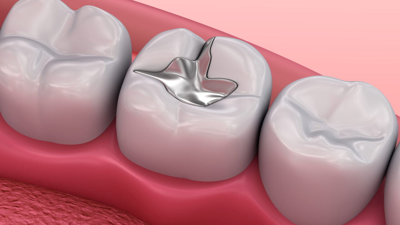 Dental Fillings Explained: When, Why, and How to Restore Your Smile