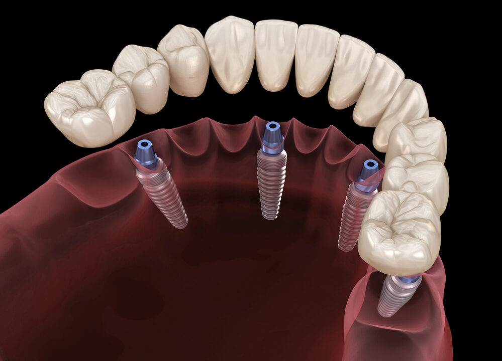 The Truth About All-on-4 Dental Implants