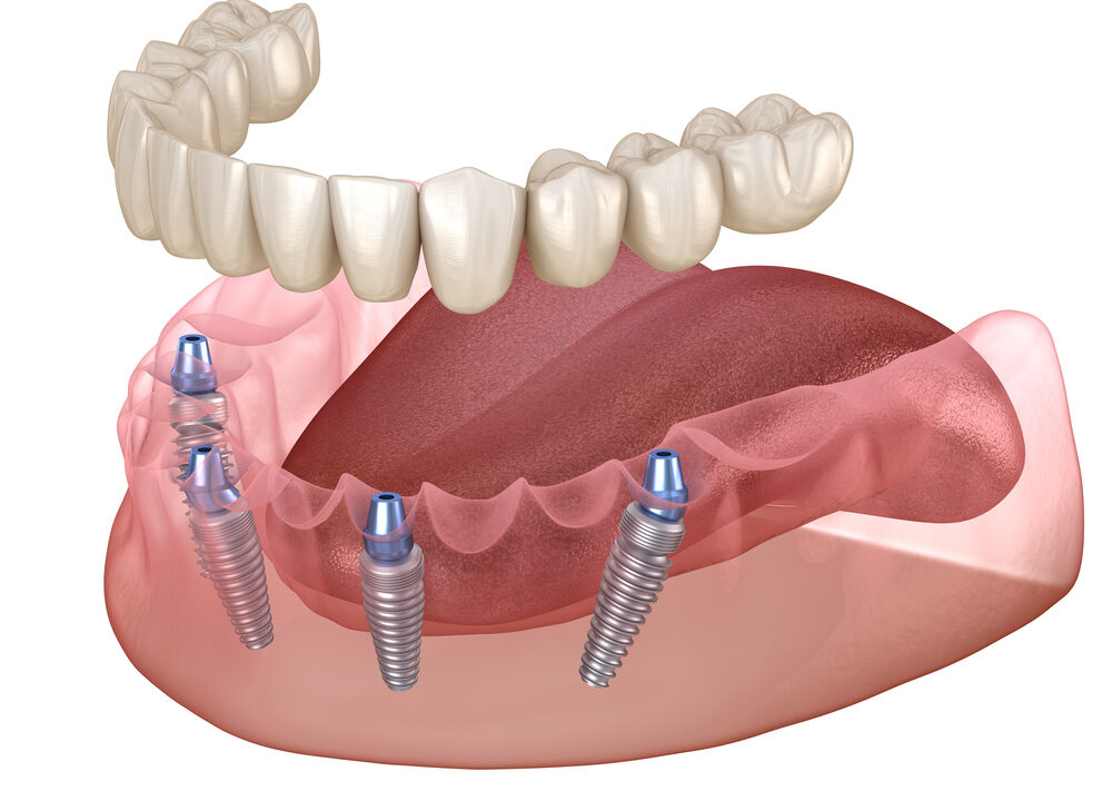 Understanding All-on-Four Technology: An Innovative Approach to Dental Restoration