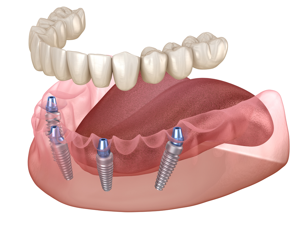 All-on-Four dental implants